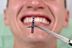 dental implants in etobicoke dentistry