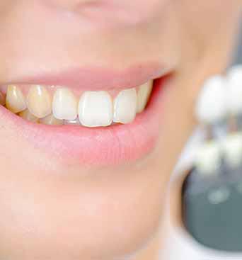 Etobicoke dentist for yellow teeth