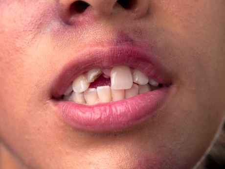 Detailed view of a woman with broken teeth, Model: Alicia Medina