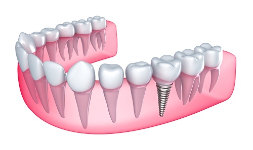 Give Yourself the Gift of Dental Implants