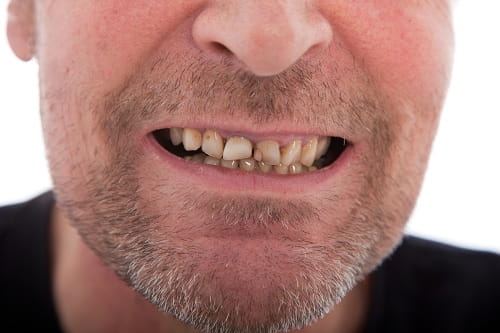 Stressful Habits That Harm Teeth