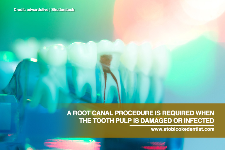 A root canal procedure is required when the tooth pulp is damaged or infected