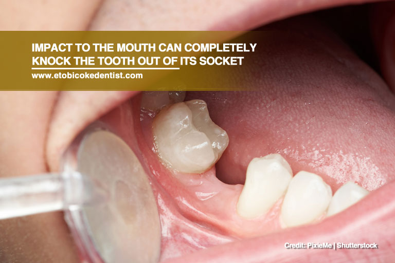 Impact to the mouth can completely knock the tooth out of its socket