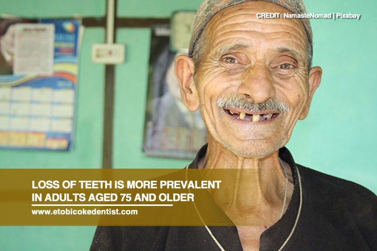 Loss of teeth is more prevalent in adults aged 75 and older