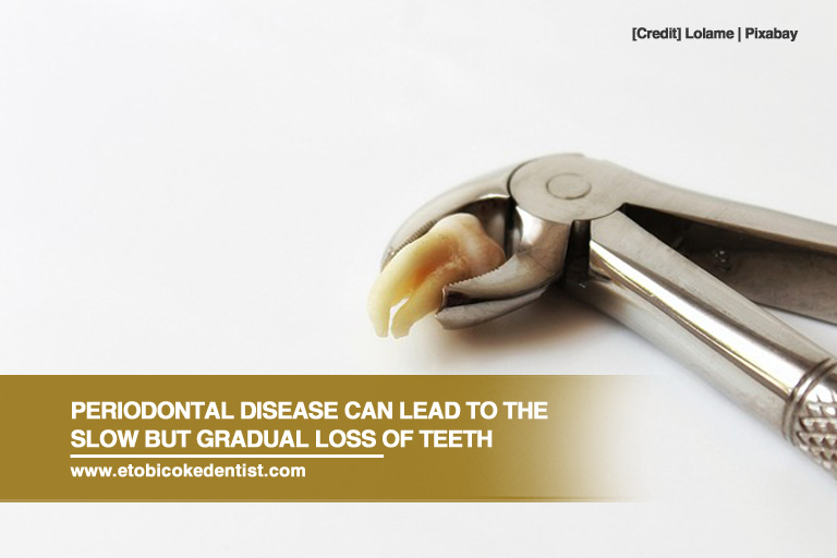 Periodontal disease can lead to the slow but gradual loss of teeth