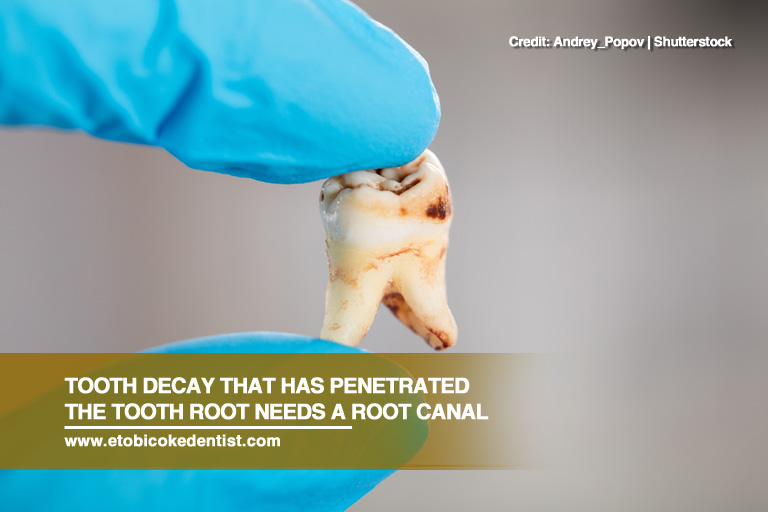 Tooth decay that has penetrated the tooth root needs a root canal