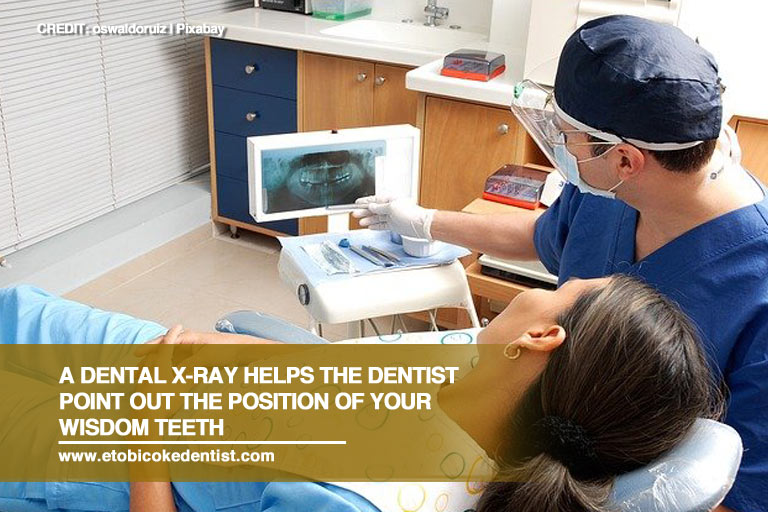 A dental x-ray helps the dentist point out the position of your wisdom teeth