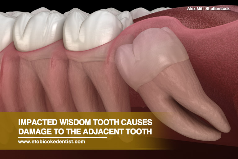 Impacted wisdom tooth causes damage to the adjacent tooth