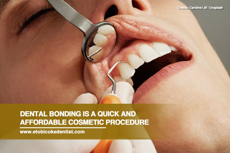 Dental bonding is a quick and affordable cosmetic procedure