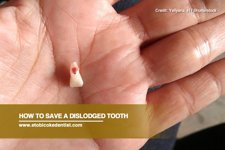 A dislodged tooth can be saved