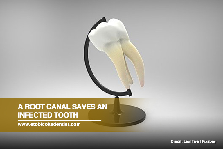 A root canal saves an infected tooth