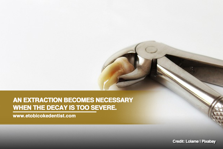 An extraction becomes necessary when the decay is too severe. 