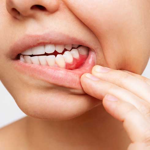 Periodontics-in-Dr.-Mark-Rhody-Dentistry